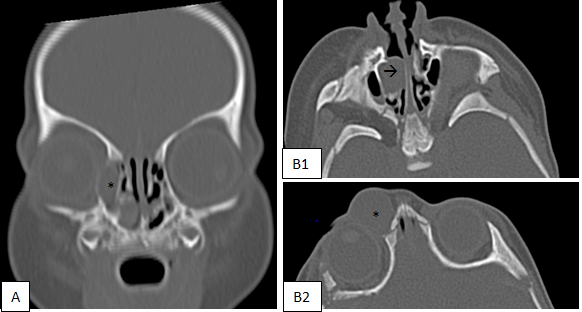 Figure 2: Clinical Evolution after Initial Intravenous Antibiotics.