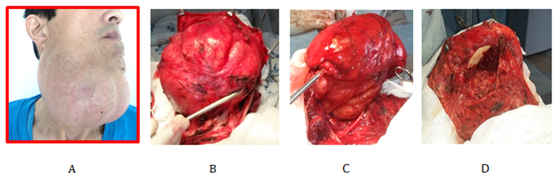 Figure 3: A Skin incision line in the submandibular region on the right B-C Step-by-step removal of a tumor in the submandibular region D After the operating bed, no bone destruction was found in the lower part of the lower jaw on the right.