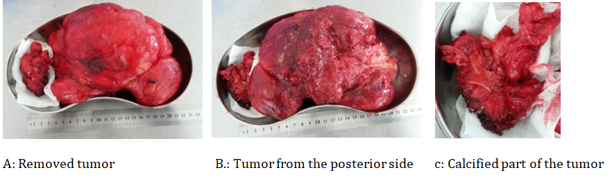 Figure 4: Macro Specimen A microscopic picture revealed adipose tissue and connective tissue (Figure 5).