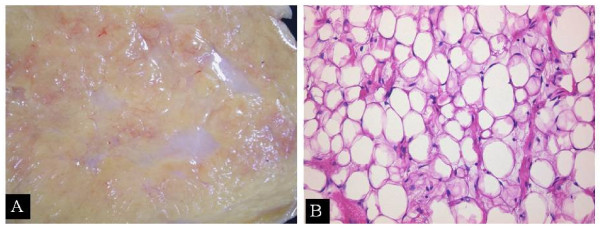 Figure 5: Microscopic picture of Adipose tissue; lipocytes with degenerative changes; in separate foci, loose fibrous connective tissue is located between the lipocytes. Color: H&E. About 40xOk100.