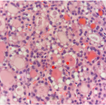 Figure 2: Signet ring stromal tumour delineating ovarian stromal cells pervaded with significant intracytoplasmic vacuoles indenting the nuclear membrane and uniform, ovoid nuclei. Circumscribing stroma is fibrotic. Cellular atypia, mitosis and necrosis are negligible (Table 1) [6].
