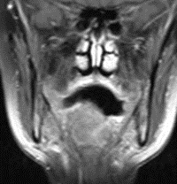 Figure 2: Central Oral and Tongue Base Endoscopic Resection.