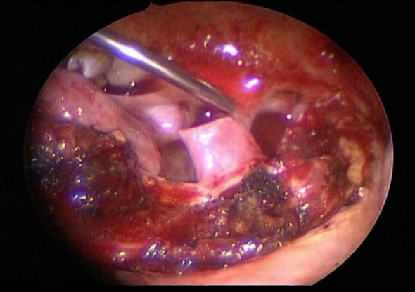 Figure 4: Epidermal Cyst of the Tongue: A CT; B: Transoral Endoscopic Ventral Resection.