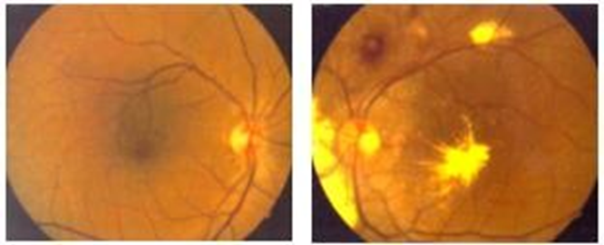 Figure 1: Color Fundus Photos of both eyes at presentation, right fundus normal, left fundus showed two macroaneurysms, one surrounded with retinal haemorrhage located one disc diameter above the optic disc, another located within the macula. There was dense deposition of hard exudates in the fovea ,nasal retina and above the upper arcade.