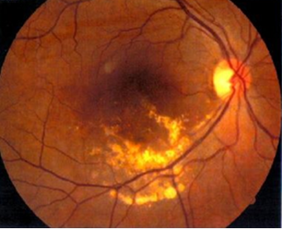 Figure 12: Colour Fundus Photo both eyes revealed obliteration of right RAM with marked disappearance of hard exudates along the inferior arcade with absence of macular oedema.