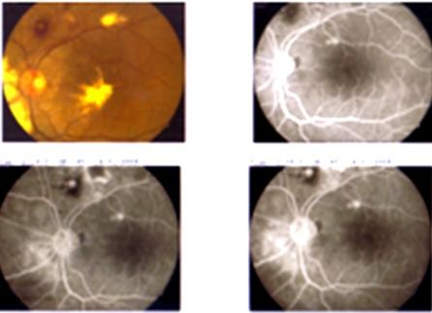 Figure 2: FFA of left eye visualized two RAMs more clearly as round hyperfluorescin spots.