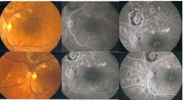Figure 4: Colour Fundus Photo of both eyes, left fundus revealed reduction of hard exudates to a minimum level with laser scar. FFA of left eye showed no dye leakage only staining of laser scar, intravascular hyperfluorescent spot has disappeared, suggesting closure of macroaneurysm.