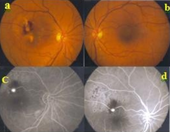 Figure 5: Optical coherence tomography at the end of follow-up with fluid and hard exudate disappearance.