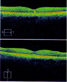 Figure 6: a,b) Color Fundus Photos both eyes after laser therapy, right fundus showed macroaneurysms,surrounded with retinal haemorrhage and hard exudates located near the fovea, left fundus normal. c,d) The fluorescein angiogram showed hyperfluorescence that corresponds to the retinal macroaneurysm, did not respond well to laser and the hypo fluorescence that corresponds to the retinal haemorrhage.