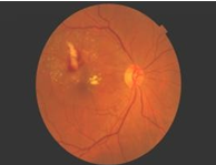 Figure 7: Right fundus revealed fibrosed RAM with decreased retinal haemorrhage and macular oedema but appearance of new hard exudate and mild NPDR.