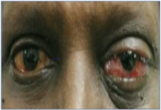 Figure 2: The resolution of chemosis and proptosis on day-6.