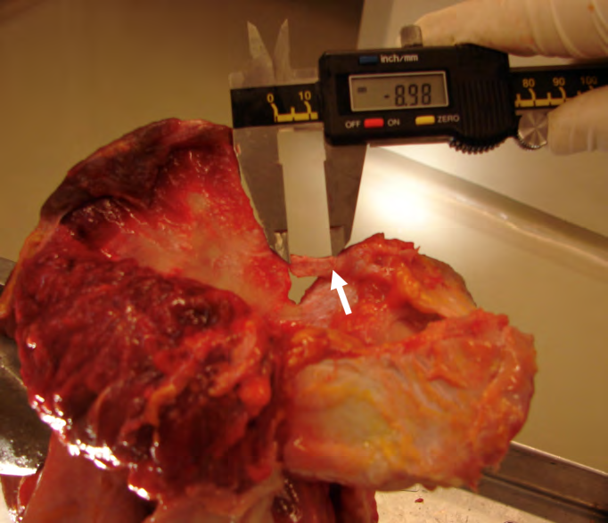 Figure 2: The dimensions of the superior transverse scapular ligament (arrow) and of the suprascapular notch were measured with a digital caliper. In this case, the suprascapular notch is V-shaped.