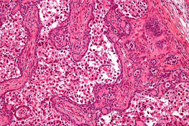 Figure 2: Gonadoblastoma delineating tubule lined by immature Sertoli cells, centric germ cells and circumscribing basement membrane. Intervening stroma exemplifies clusters of enlarged, polygonal cells akin to Leydig cells [6].