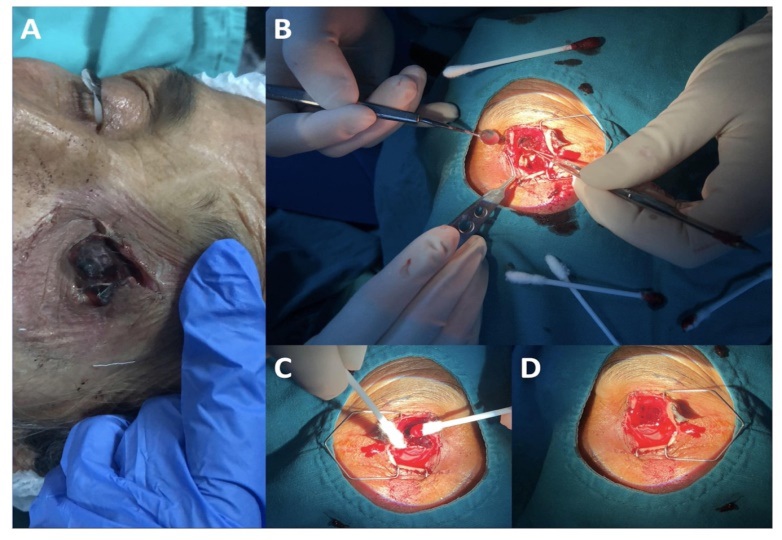 Figure 1: The patient was a 90-year-old female, diagnosed with Alzheimer’s disease, injured by self-mutilation, and had no caregivers. Per-operative photographs of the patient (A-D).