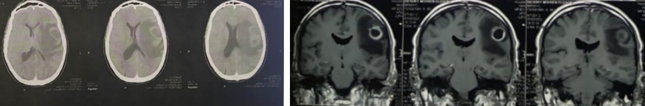 Figure 1: CT brain of a male patient with history of chronic headache for one and have months associated with vomiting, epilepsy, slurred speech, and right-side weakness Grade 4, treated with intravenous antibiotics for 2 weeks because the first CT and MRI brain were not conclusive for brain abscess.
