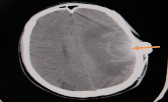 Figure 2: localization and marking site of the burr hole for aspiration of the abscess.