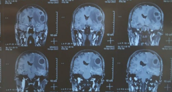 Figure 3: MRI brain of the same patient axial and coronal cuts shows progression of the abscess instead of intravenous antibiotics for more than 7 days.