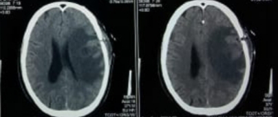 Figure 5: CT brain of the same patient after second aspiration show no more abscess formation and regression of brain edema.