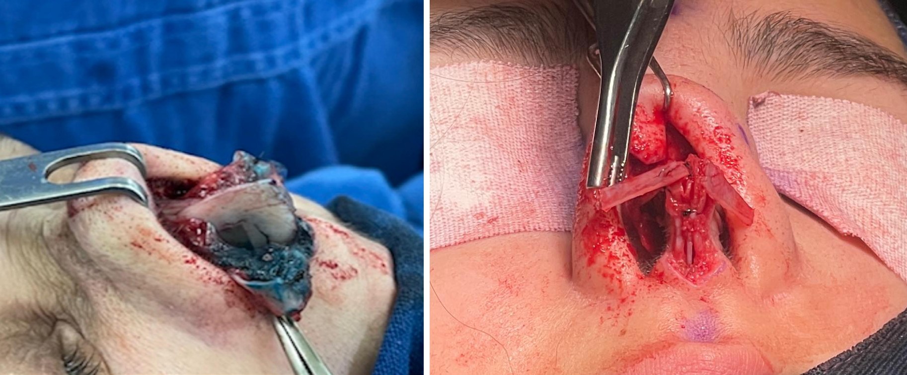 Figure 1: Septal Extension Graft.