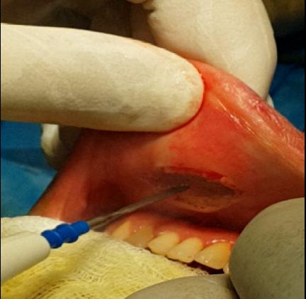 Figure 1: A 10-mm transverse incision was performed in midline of the vestibule and extended in depth up to the mandible symphysis.