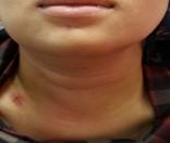 Figure 7: 2 weeks postoperative.