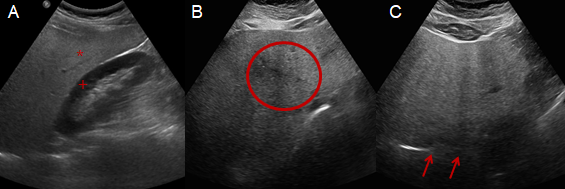 Figure 1: An intercostal scan showing increased echogenicity in the hepatic parenchyma (*) in comparison to the renal cortex (+) (A). A subcostal scan illustrating impaired visualization of periportal vein echogenicity (circled) (B). A subcostal scan depicting severely increased echogenicity of the hepatic parenchyma, with the diaphragm poorly visualized (indicated by arrows) (C).