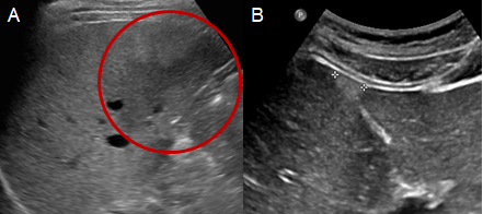 Figure 2: A focal fat sparing zone is displayed, which is hypoechoic compared to the surrounding parenchyma (circled) (A). An area of focal fat deposition is shown, which is hyperechoic compared to the surrounding parenchyma (B).