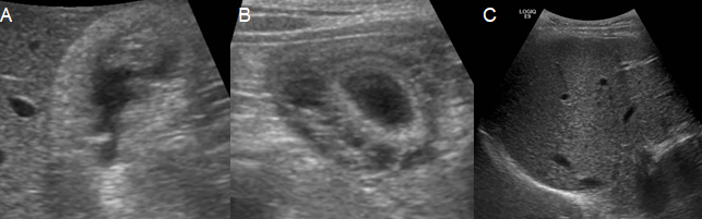 Figure 3: Ultrasonographic findings of a patient with acute hepatitis A. Pericholecystic edema is evident in the intercostal scan (A) and in the subcostal scan (B). The subcostal scan shows severe hyperechogenicity of the liver parenchyma and displays the ‘starry night’ liver sign, consistent with acute hepatitis (C).