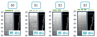 Figure 6: Liver stiffness measurement by transient elastography (FibroScan®), showing the steatosis grade ranging from S0 to S3 according to the amount of fatty change.