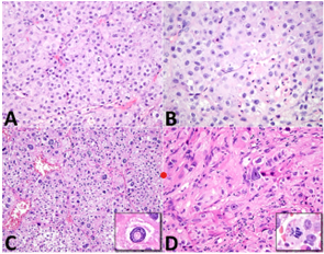 Figure 2: Leydig cell tumour demonstrating variable morphology with solid cellular nests pervaded with abundant, granular, eosinophilic cytoplasm and uniform nuclei with prominent nucleoli [6].