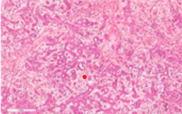 Figure 1: Combined hepatocellular carcinoma and cholangiocarcinoma composed of cuboidal cells impregnated with pale, pink cytoplasm, intermingled with glandular articulations layered with malignant epithelium and an encompassing fibrotic stroma [5].