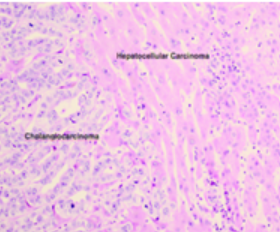 Figure 2: Combined hepatocellular and cholangiocarcinoma demonstrating cuboidal cells pervaded with abundant eosinophilic cytoplasm and commingled glandular structures layered with malignant epithelium and circumscribing fibrotic stroma [6].