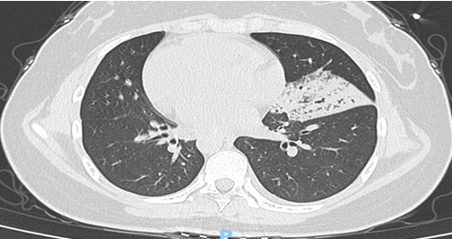 Figure 2: CT at admission: mirror right middle lobe (left middle lobe) massive pneumonia with lung tissue consolidation and atelectasis, mirror right thorax (left thorax) a small amount of pleural effusion.