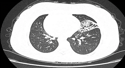 Figure 4: Perfect CT of nasal sinuses: chronic inflammation of bilateral maxillary sinuses, ethmoid sinuses, and sphenoid sinuses, and the final clinical diagnosis is Kattagne syndrome (KS).
