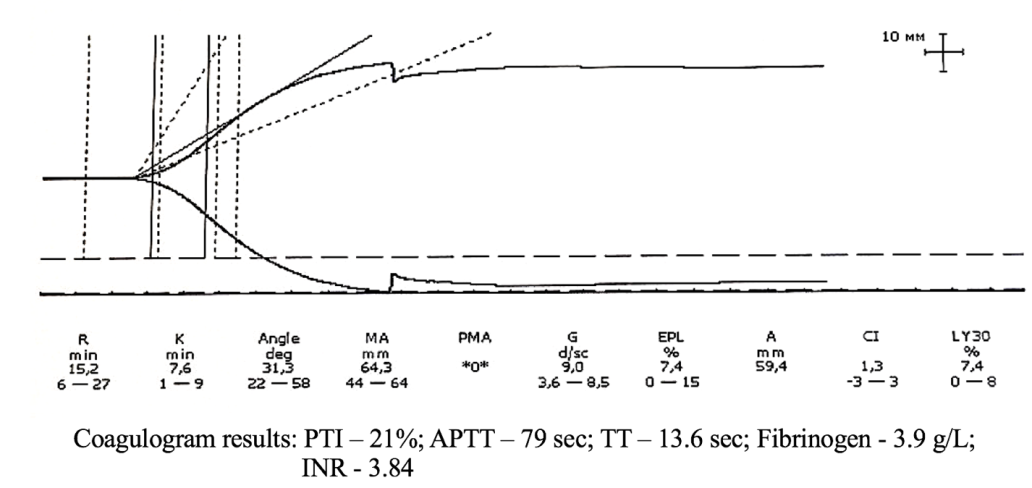 Figure 7: In Figure 7, the coagulogram parameters indicate pronounced signs of hypocoagulation that require urgent pharmacological correction. Conversely, the thromboelastogram (TEG) data demonstrate increased platelet aggregation. However, the hemostatic system remains balanced.