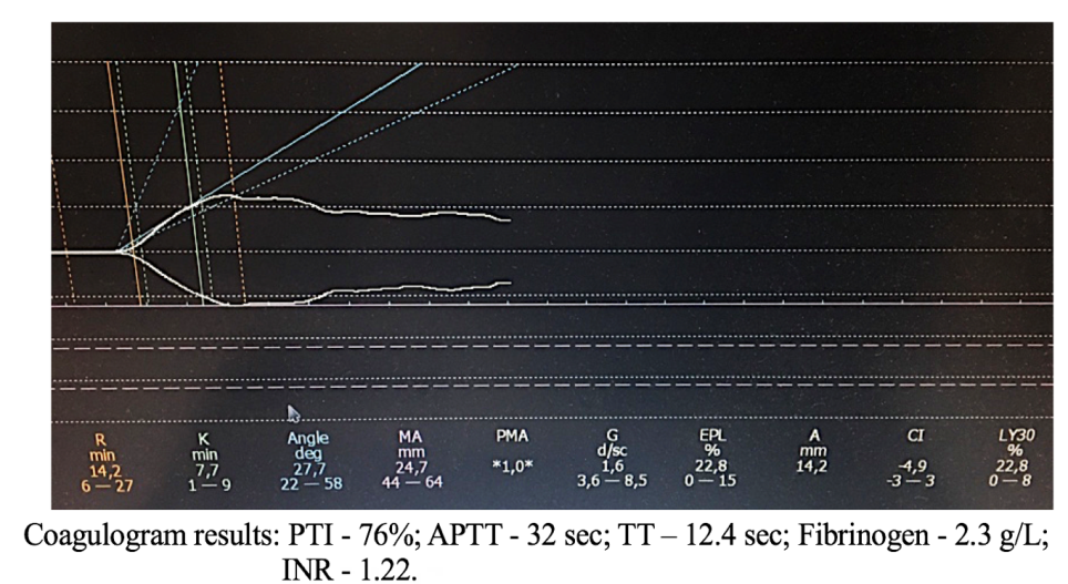 Figure 8: Figure 8 demonstrates that the coagulogram parameters are mostly within the normal range. However, the TEG clearly registers a decrease in the coagulation index due to platelet aggregation inhibition. Thus, the presented clinical examples vividly demonstrate that based solely on coagulogram parameters, a physician cannot adequately assess and perform effective hemostasis correction. Ignoring this fact can lead to the rapid development of life-threatening complications for the patient. Evaluation of the clotting system and monitoring of antiplatelet and anticoagulant therapies should be based solely on a comprehensive analysis. Analysis of the hemostatic system, along with coagulogram data, must necessarily include TEG parameters, which are crucial. Additionally, other clinical and laboratory indicators, as well as immunological and biochemical research data, should be taken into account. These indicators characterize the state of the body’s internal environment and directly or indirectly influence hemostasis. For example, this includes liver enzyme activity, platelet count, homocysteine level, immunoglobulins, acute-phase proteins, blood oxygen levels, and so on.
