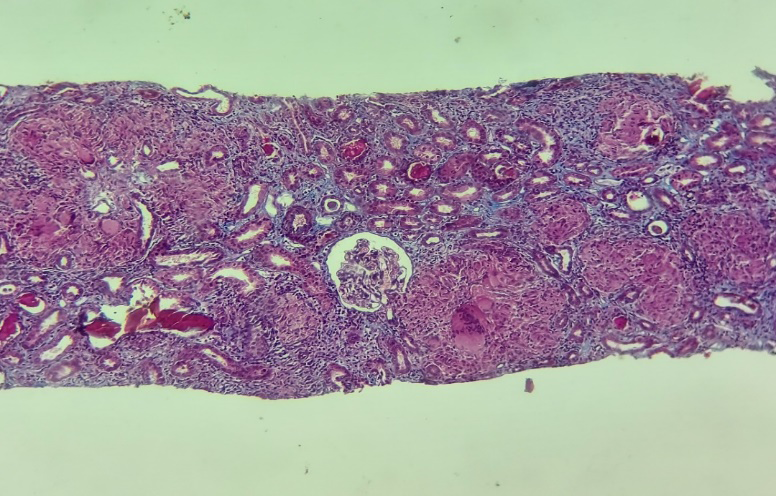 Figure 1: Giganto-cellular interstitial infiltrate with follicles tending to confluence and destroying tubules (yellow arrow); (HESx400).