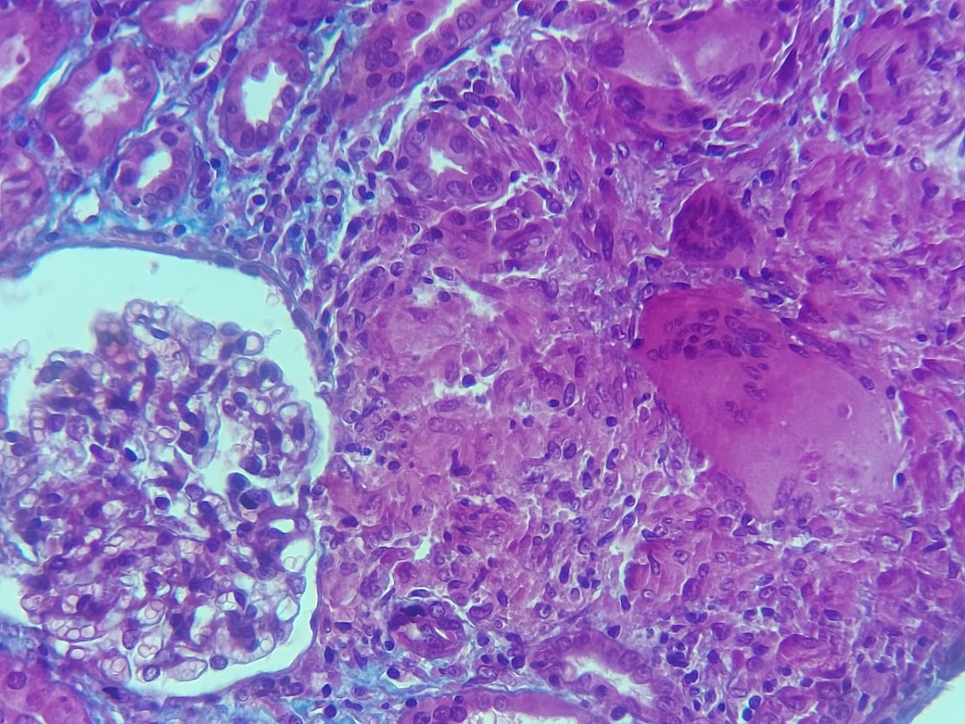 Figure 2: Epithelioid and gigantocellular granuloma with central fibrinoid necrosis (black arrow); Normal appearance glomerulus (yellow arrow) (HES × 100).