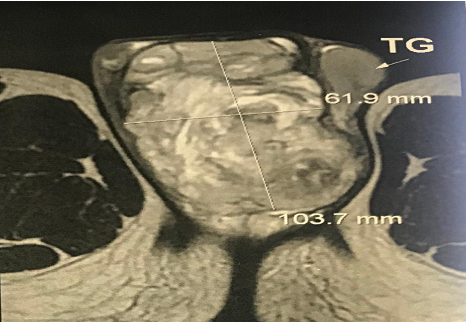 Figure 2: The tumor markers were normal. A biopsy was performed objectifying a rhabdomyosarcoma. The patient received three courses of neoadjuvant chemotherapy followed by inguino-scrotal tumerectomy. Histological examination showed embryonic rhabdomyosarcoma with round cells from the paratesticular region.
