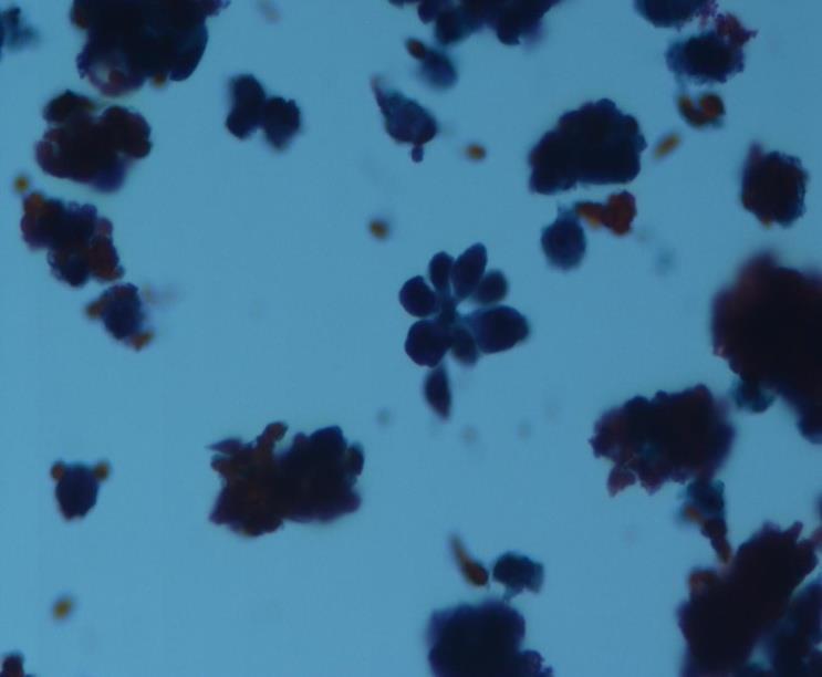 Figure 1: Atypical cells with a narrow cytoplasm, separately or in groups with a vesicular nucleus were observed in the FNAC (X40). The FNAC showed a malignant tumor, possibly large cell lymphoma. A right superficial parotidectomy and right neck dissection of levels 1–4 were performed on the patient. A well-defined, necrotic, off-white to yellow solid tumor measuring 4×2.5×2.5 cm was observed in the cross section of the salivary gland, which measured7.5×3.5×3 cm (Figure 2). A tumor was observed in the histopathological examination of the mass. It comprised cells with eosinophilic cytoplasm with prominent nucleoli, irregular nuclear contours, and pleomorphism. Tumor cells formed solid islands and cords. There were many mitotic figures, giant cells (Figure 3), large necrosis areas, perineural invasion, and mild lymphoplasmacytic cell infiltrations. NSE (Figure 4), CD56, and EMA were stained positively in the immunohistochemical examination.