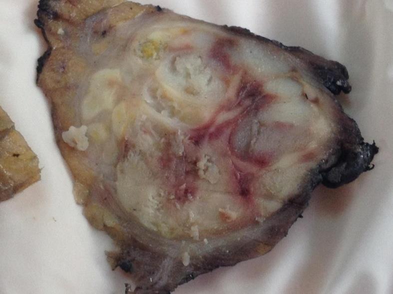 Figure 2: A well-defined, necrotic, off-white to yellow solid tumor in the cross section of the salivary gland.