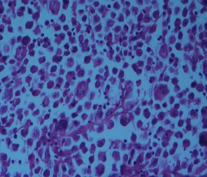 Figure 3: Microscopically tumor cells formed solid islands and cords. There were many mitotic figures, giant cells (HEX20).