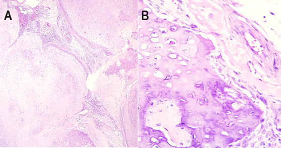 Figure 2: Histopathology. A. Mesenchymal proliferation with expansive growth, with stretches forming lobular outlines delineated by bundles of fusiform cells. Inside the lobes, presence of atypical cartilaginous component, areas of ossification and foci with immature osteoid matrix (Hematoxylin/Eosin stain, 4x magnification). B. Presence of tumor cells with a fusiform or rounded appearance, with rounded to oval nuclei (Hematoxylin/Eosin stain, 40x magnification). Font: [4].