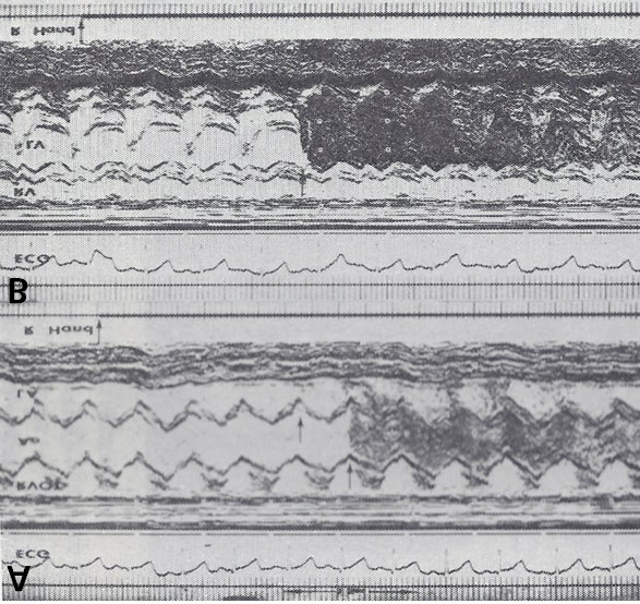 Figure 1: Selected M-mode recordings from the parasternal short axis view of the left atrium (LA), aorta (Ao), and right ventricular outflow tract (RVOT), made while injecting agitated saline into veins of the right (R) hand, which demonstrate the appearance of contrast echoes in the LA (arrow) first and then the Ao (arrow). B: Similar tracings of the left ventricle (LV) and right ventricle (RV) demonstrate the appearance of contrast echoes in the LV (arrow) without contrast in the RV. Similar findings were seen while injecting agitated saline into the veins of the left hand. These recordings indicate the drainage of the superior vena cava into the left atrium. The start of the agitated saline injection is marked with arrows at the bottom of each tracing. ECG, electrocardiogram. Modified from Truman TA, et al. [4].