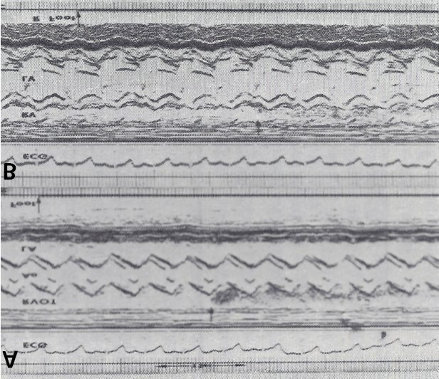 Figure 2: Recordings similar to those shown in Figure 1 were made while injecting agitated saline into the veins of the feet, and these reveal contrast in the right ventricular outflow tract (RVOT) (A) and right ventricle (RV) (B) (arrows in A and B) suggesting that the inferior vena cava drains normally into the right atrium (not shown) and RV. The start of the agitated saline injection is marked with arrows at the bottom of each tracing. ECG, electrocardiogram. Modified from Truman TA, et al. [4].