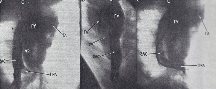 Figure 3: Angiographic frames from injections into the right innominate (A and B) and left innominate (LInV) (C) veins demonstrating direct opacification of the right superior vena cava (SVC), left atrium (LA), left ventricle (LV) and aorta (Ao) without opacification of the right heart structures. C, Catheter. Reproduced from Truman TA, et al. [4].