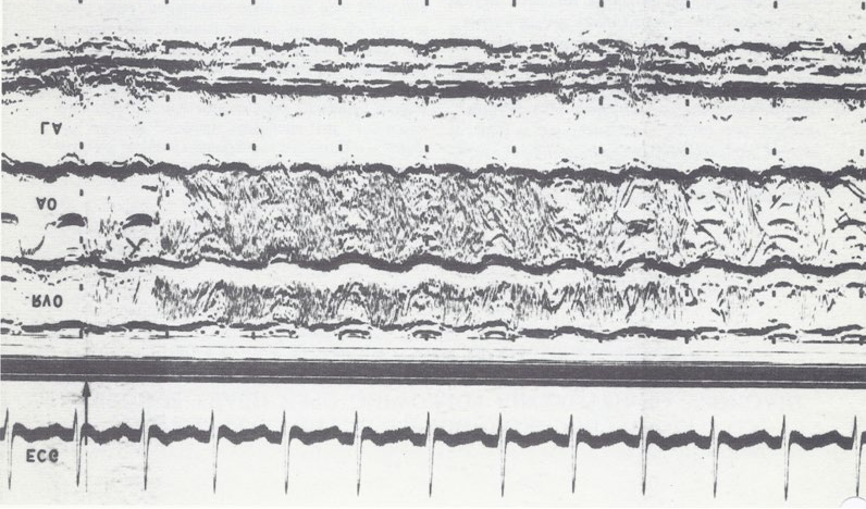 Figure 7: First-pass radionuclide angiographic study of the patient with an anomalous connection of the right superior vena cava to the left atrium. A. When radionuclide material (tecnetium-99m macro-aggregated albumin) was injected into a vein in the foot, the inferior vena cava (IVC), right ventricle (RV) and lungs were seen, indicating normal drainage of the IVC into the right atrium. B. When the injection was made into a vein of the left hand, the left (L) arm vein, the superior vena cava (not marked), left atrium (not marked), left ventricle (LV) and aorta (AO) were seen, indicating the anomalous entry of the superior vena cava into the LA. Reproduced from Rao PS [6].