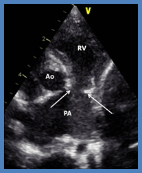 Figure 1: Selected video frame from a 2-D echocardiogram in a parasternal short axis view demonstrating rudimentary pulmonary valve leaflets (arrows) and dilated main and proximal portions of the right and left pulmonary arteries. Ao, aorta; PA, pulmonary artery; RV, right ventricle. Reproduced from Alapti S, et al. [10].