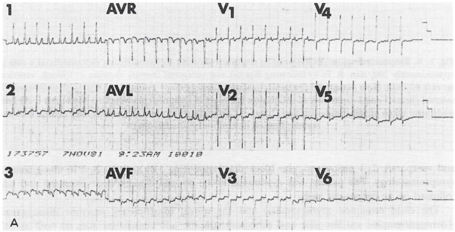 Figure 10: Electrocardiogram at presentation showing supraventricular tachycardia (200 beats per minute). Reproduced from Rao PS, et al. [20].