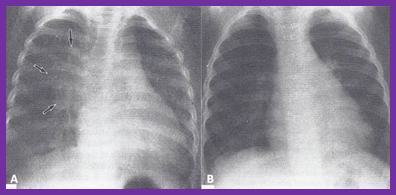 Figure 3: Continuous wave Doppler recording across the right ventricular outflow tract in the same neonate as shown in Figures 1 & 2 demonstrates a severe gradient across the pulmonary outflow tract (87 mmHg – see insert) and pulmonary insufficiency (PI). PS, pulmonary stenosis. Reproduced from Alapati S, et al. [10].